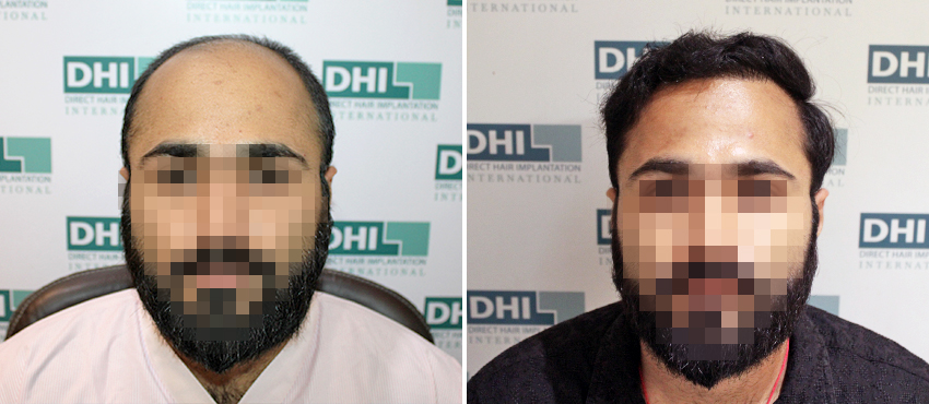 DHI before & after hair transplant results